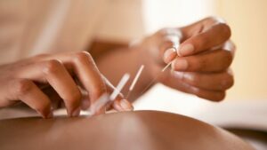 Amenorrhea: How to Restart Your Menstrual Cycle With Acupuncture
